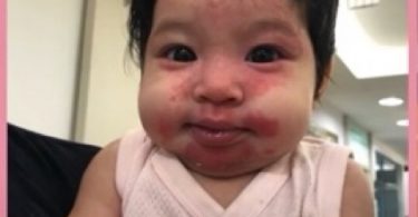เปิดภาพอาการแพ้ “น้องปรางลูกสาว มิค-เบนซ์” จนต้องพันตัวเป็นมัมมี่