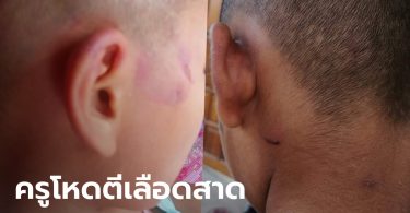 เด็กอนุบาล 3 บวกเลขไม่ได้ ครูคว้าไม้บรรทัดตีหัวเลือดสาด ขอจ่าย 1 หมื่นให้จบเรื่อง