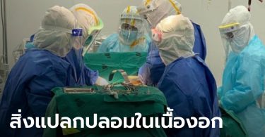 หมอตะลึง! ผ่าก้อนเนื้องอกรังไข่ คนไข้สาววัย 17 เจอกระจุกเส้นผม กระดูก เล็บ ฟัน