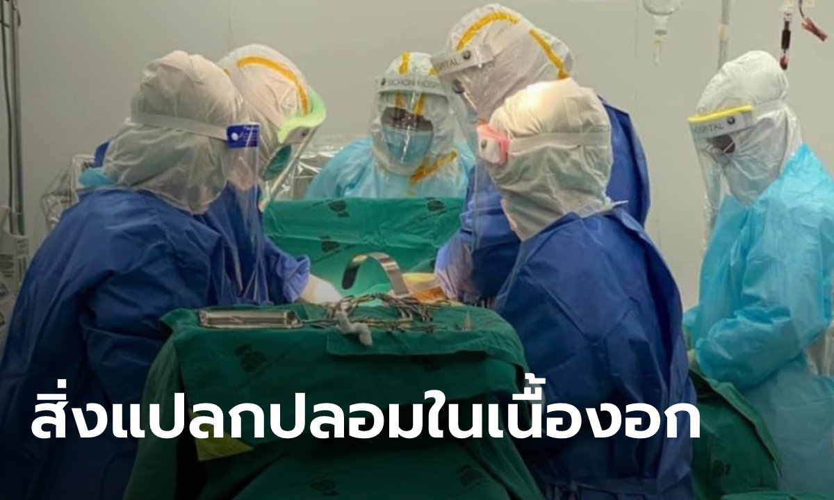 หมอตะลึง! ผ่าก้อนเนื้องอกรังไข่ คนไข้สาววัย 17 เจอกระจุกเส้นผม กระดูก เล็บ ฟัน