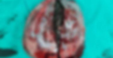 Hair, fingernail, teeth found in young woman’s ovary not black magic